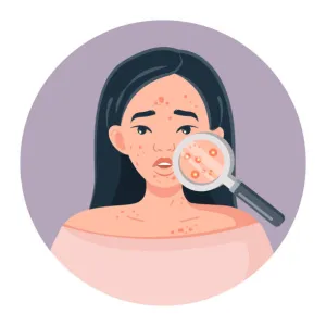 acne issues