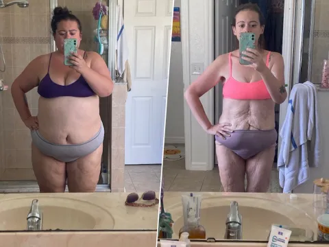 Caitlyn Before and After surgery