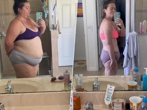 Caitlyn Before and After Surgery