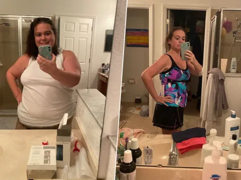 Caitlyn Before and After Surgery