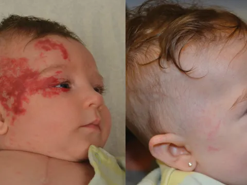 Before and After child with hemangioma