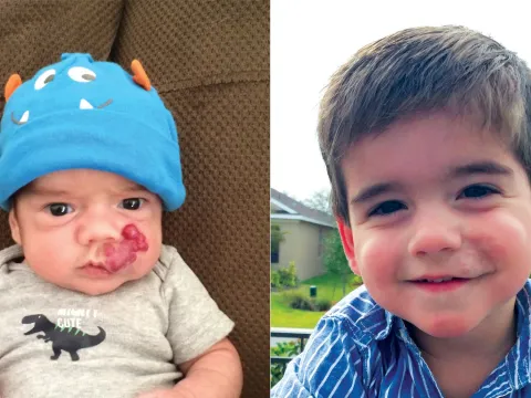 Birthmark Surgery Before & After