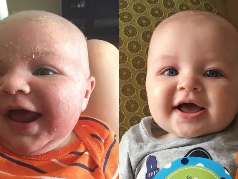 Birthmark Surgery Before & After