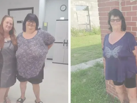 "Weight Loss Surgery Saved My Life" - Sam