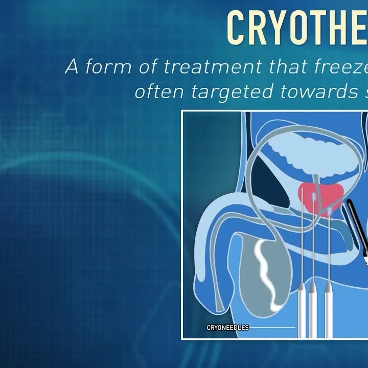 What is Cryotherapy? | Global Robotics Institute | AdventHealth