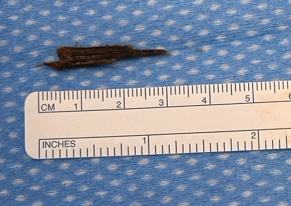 Surgeon at AdventHealth New Smyrna Beach saves patient's hand after removing large, hidden splinter that was causing serious infection
